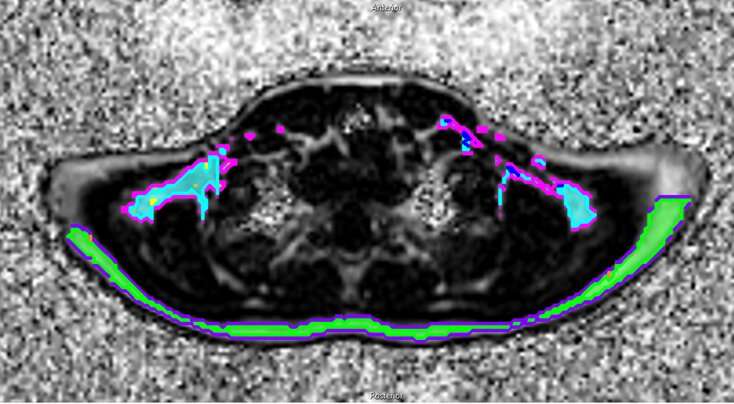 Energy-burning brown fat less active in boys with obesity 