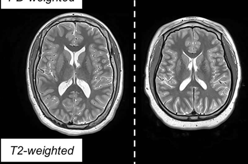 MRI identifies markers of atypical brain development in children born preterm 