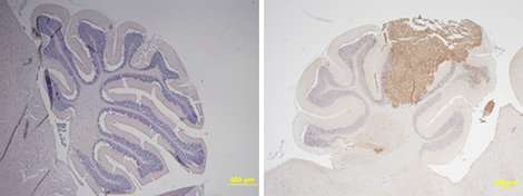 In the eye of the medulloblastoma