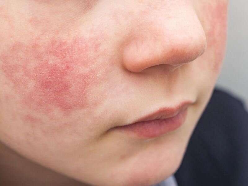 Severe eczema tied to depression, internalizing behaviors in children