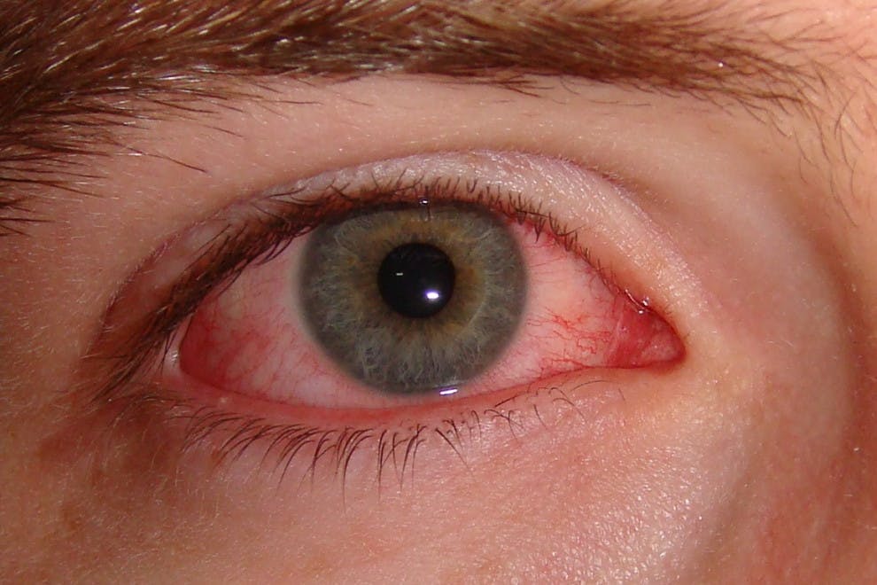 Los 5 tipos de Conjuntivitis (causas, síntomas y tratamiento)