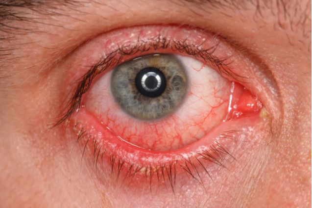 Los 5 tipos de Conjuntivitis (causas, síntomas y tratamiento)