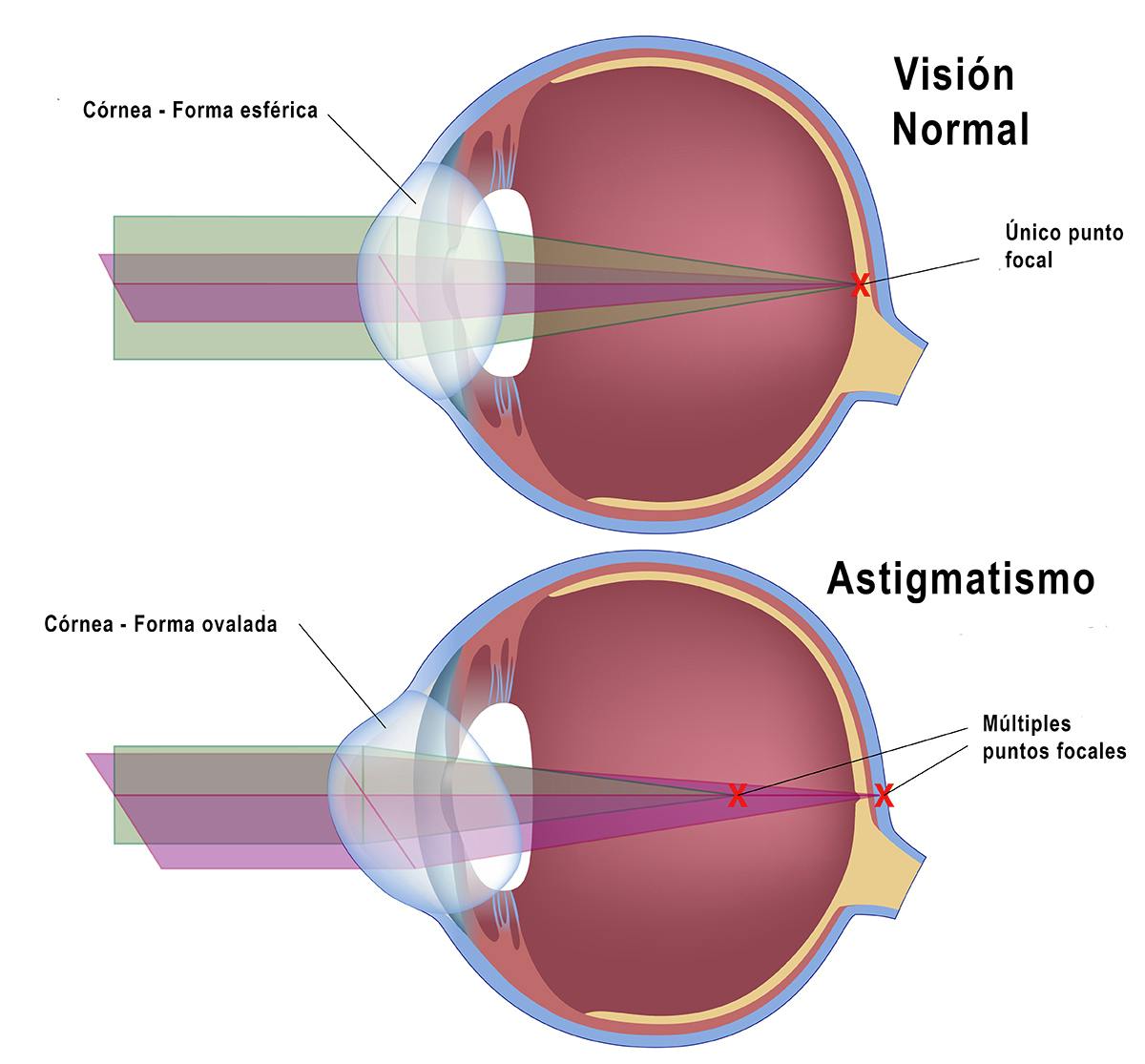 Las 3 diferencias entre miopía y astigmatismo
