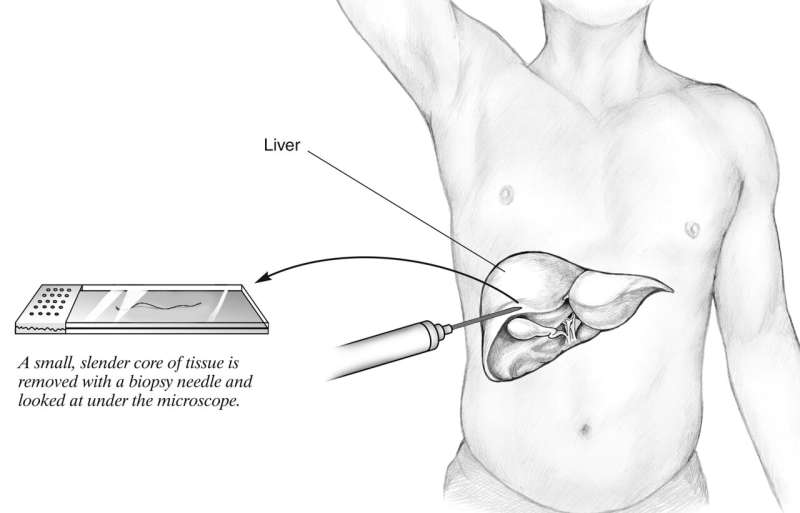 Finding the right diagnosis with liver biopsy