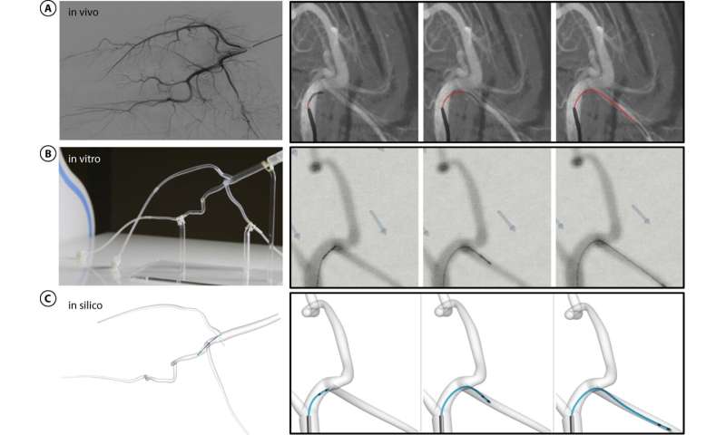 Magnetically operated robot can move through arteries to treat stroke patients