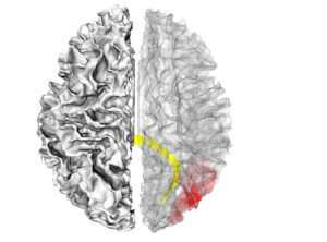 Visual system brain development implicated in infants who develop autism