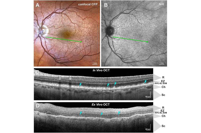 Study uses new tools, machine learning to investigate major cause of blindness in older adults