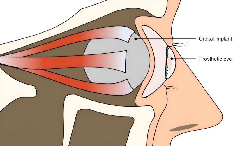 Using 3D printing to make artificial eyeballs more quickly and accurately