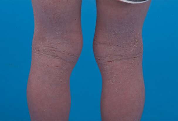 New drug therapy for young children with severe eczema 