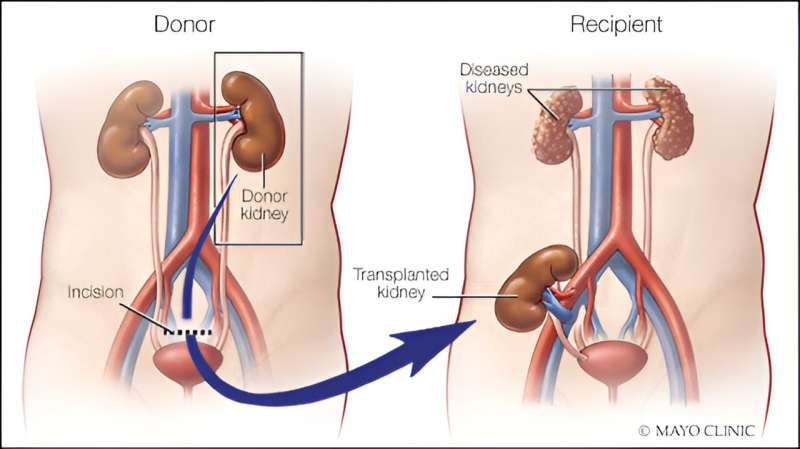 Expanding the living kidney donor pool to those with Type 2 diabetes