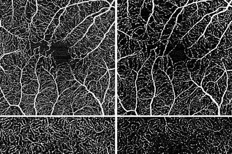 Researchers test new imaging method for monitoring intermediate uveitis, a rare eye disease