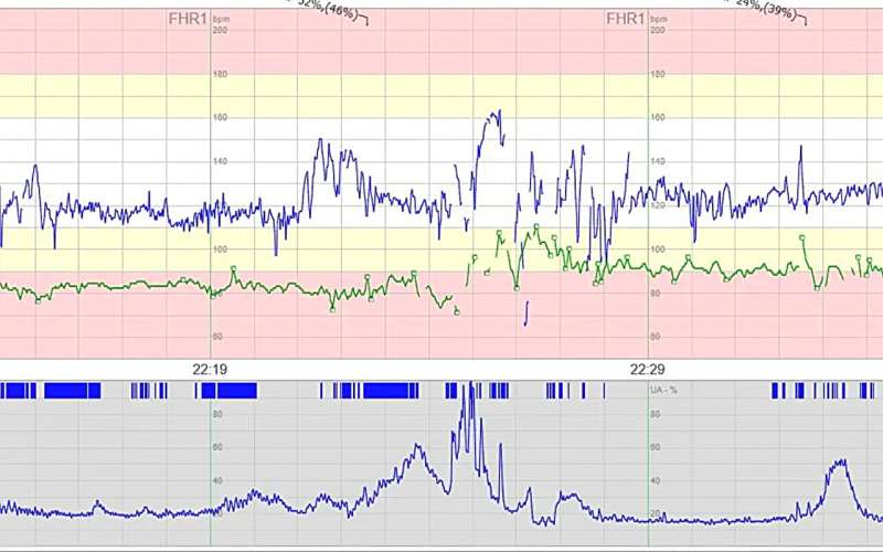 Large Finnish study finds that maternal pulse recording during childbirth prevents encephalopathy in newborn babies