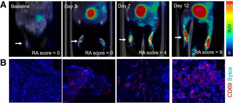 New PET tracer detects inflammatory arthritis before symptoms appear