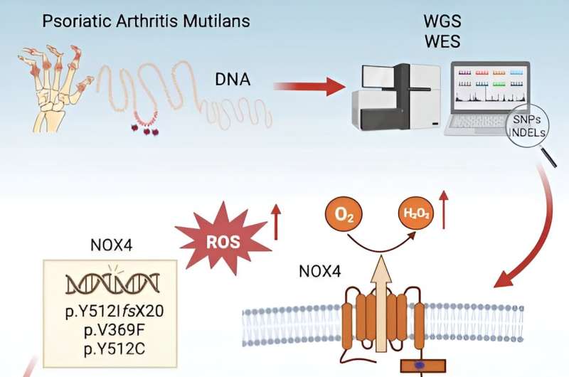 New discovery could lead to better treatment for severe psoriatic arthritis