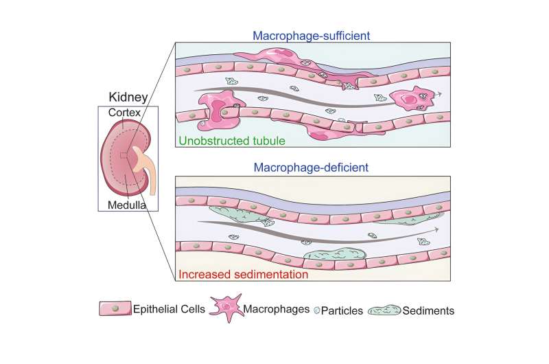 Renal macrophages observed playing crucial role in preventing kidney stones