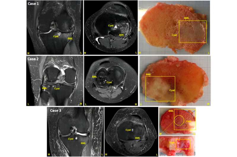 New bone tool could offer speedy screening for new treatments targeting pain in osteoarthritis