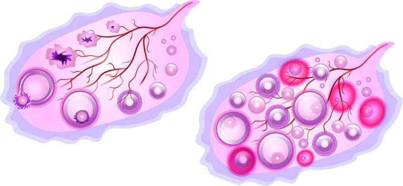 Polycystic ovaries