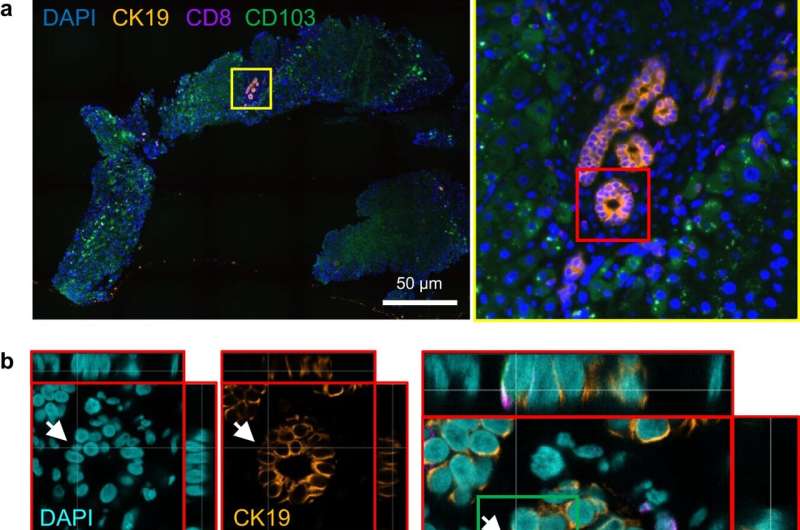 Research into autoimmune liver condition suggests unique cell movements may drive disease