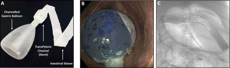 Incisionless device could revolutionize treatment  for diabetes, liver disease and severe obesity