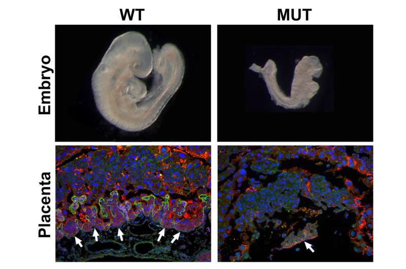 Placenta defects a factor in prenatal deaths