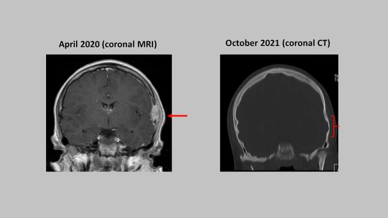 Surgery may be avoided for children with rare skull tumor 