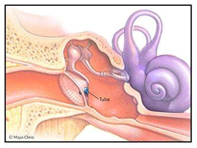 Does my child need ear tubes?