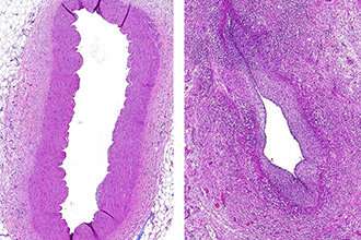 New way to prevent heart complications in children with Kawasaki disease 