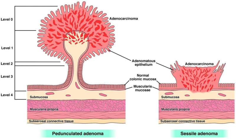 Experts release new management strategies for malignant colorectal polyps