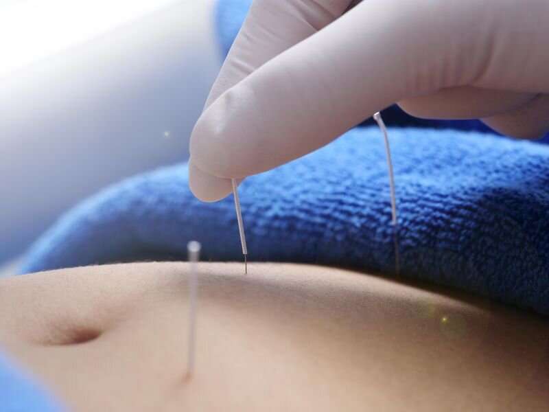 Acupuncture may aid irritable bowel syndrome with diarrhea 