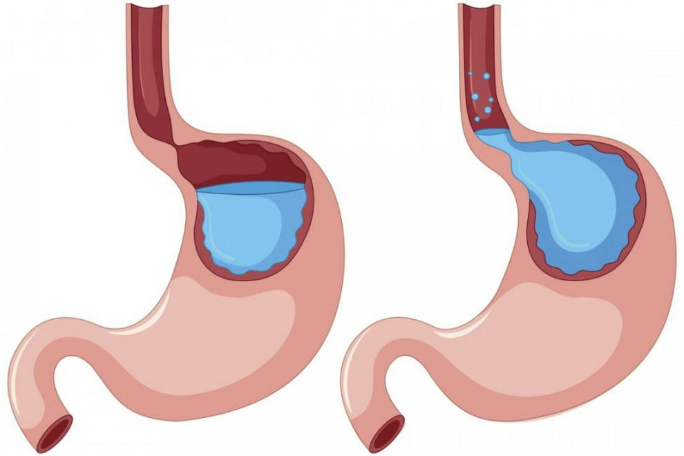 Cómo curar el reflujo gástrico (13 remedios contra la acidez)