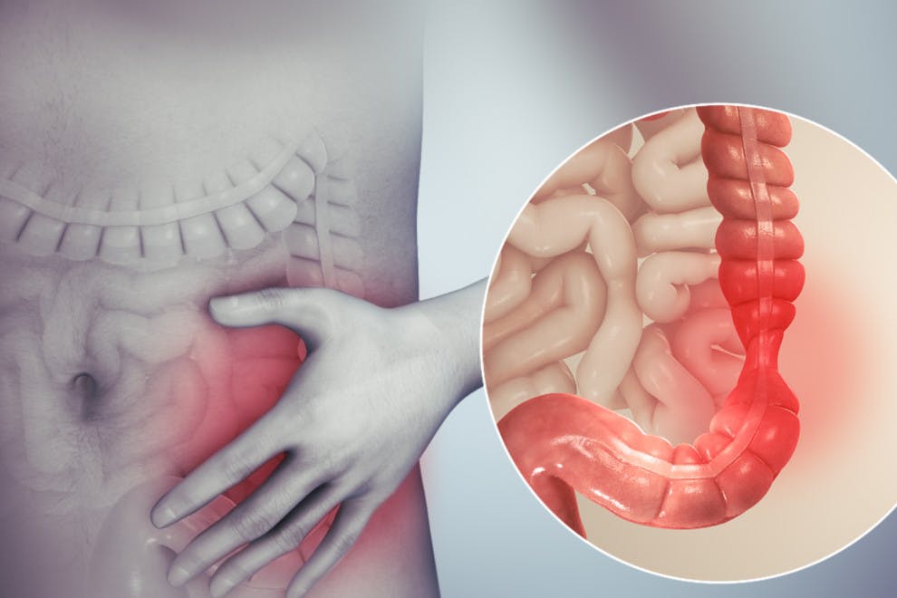 Síndrome de intestino irritable (SII): causas, síntomas y tratamiento