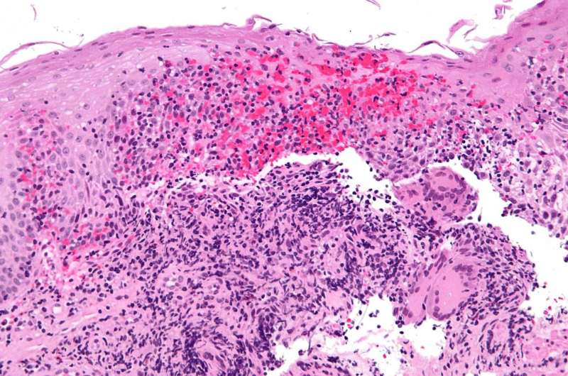 Treating newly-diagnosed Crohn's patients with advanced therapy leads to dramatic improvements in outcomes