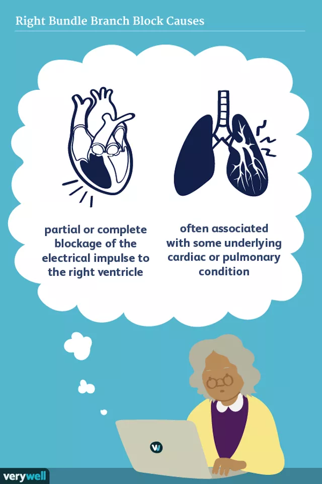 What Is a Bundle Branch Block?