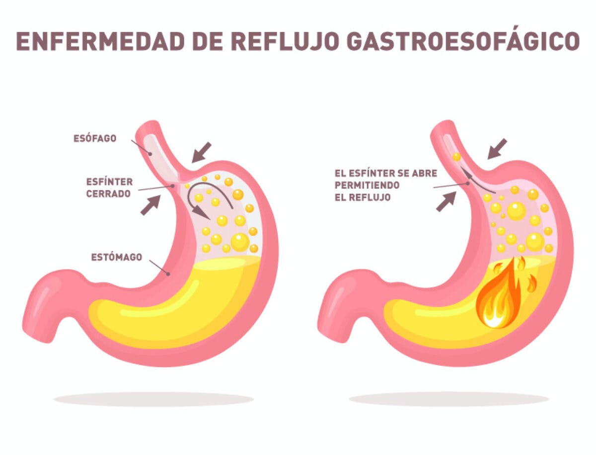 Las 10 enfermedades estomacales más comunes (causas, síntomas y tratamiento)