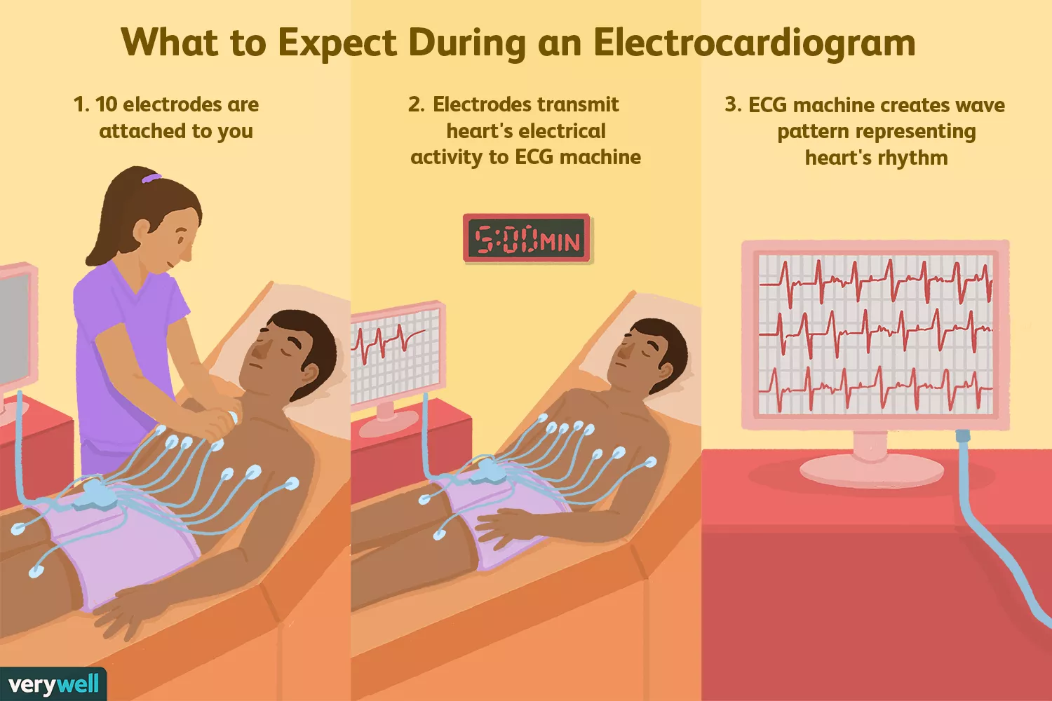 What Is an Electrocardiogram (EKG or ECG)?