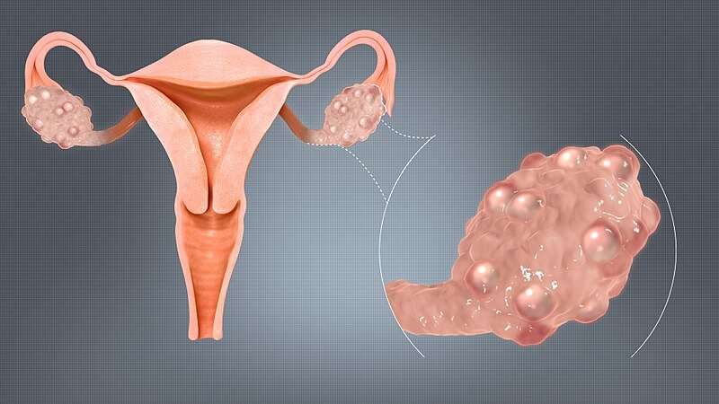 Review paves the way for better diagnosis and care for polycystic ovary syndrome 