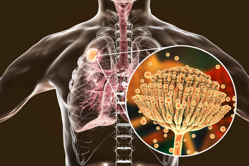 Aspergilosis: causas, síntomas y tratamiento