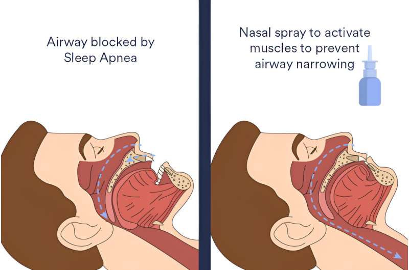 Sleep apnea solution could be right under your nose