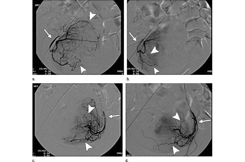 Uterine fibroid embolization helps restore fertility 