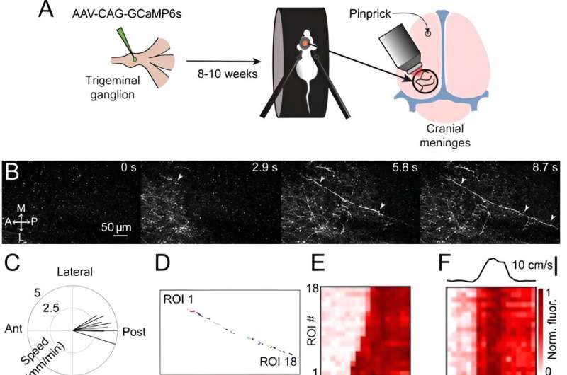 Researchers explore the connection between migraine headache and movement