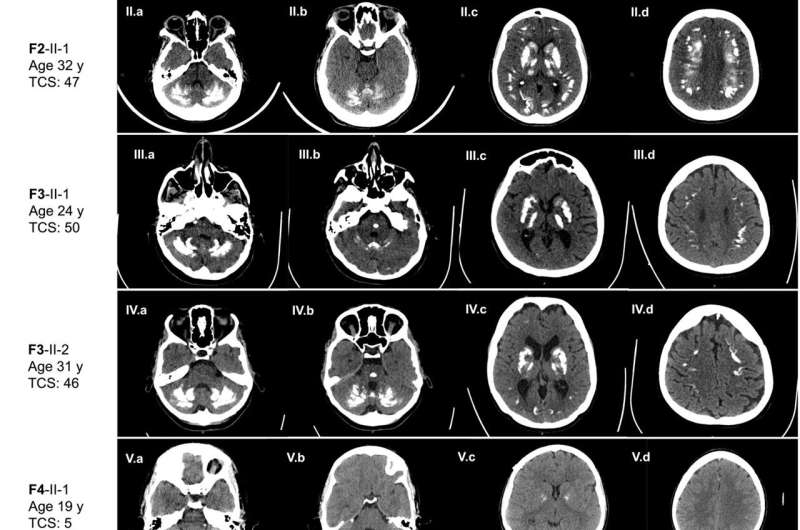 Shedding new light on brain calcification