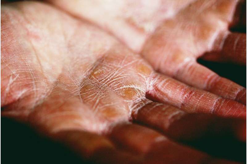 How does climate change affect eczema? 