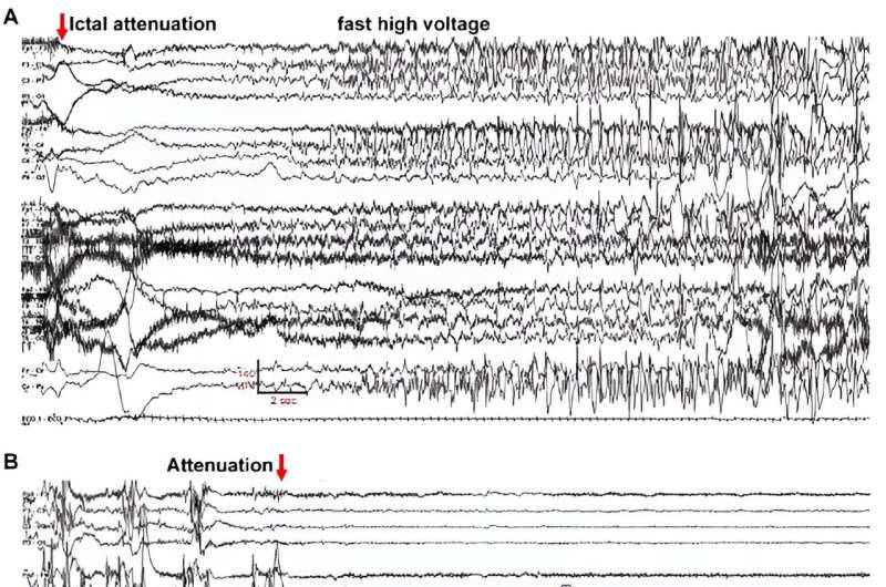 Study reveals key mechanisms of rare form of epilepsy