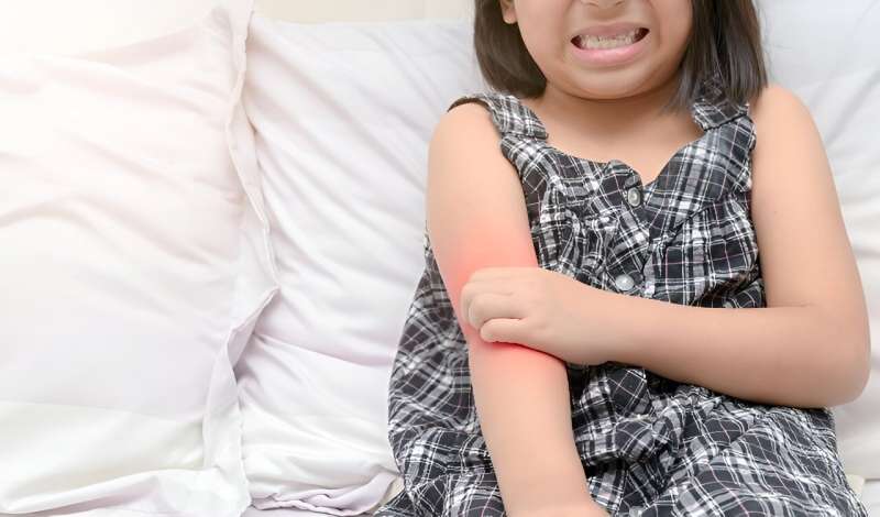 Atopic dermatitis in children tied to learning, memory difficulties 