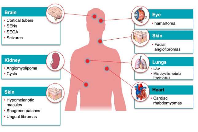 Re-defining the choice of surgery in patients with tuberous sclerosis complex