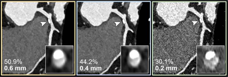 Coronary CT angiography for the suspected progression of known coronary artery disease in a 56-year-old female patient. Curved multiplanar reconstructions with 0.6-mm (yellow outline), 0.4-mm (blue outline), and 0.2-mm (green outline) section thickness show the respective calcified plaque (arrowheads) and coronary stenosis (inset images). The reduced section thickness leads to less calcium blooming and therefore a less severe assessment of percentage of coronary stenosis in this patient. Credit: Radiological Society of North America