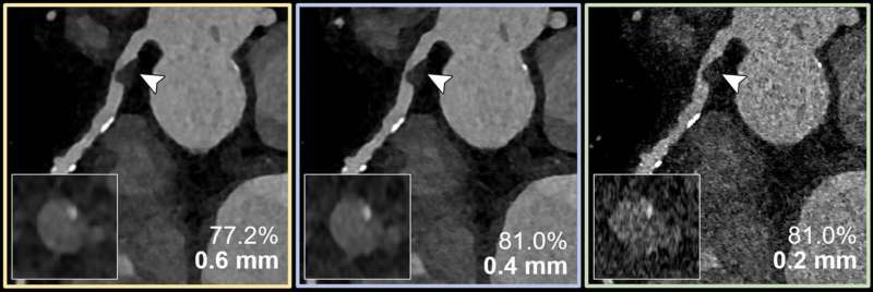 Coronary CT angiography for the suspected progression of known coronary artery disease in a 60-year-old female patient. Curved multiplanar reconstructions with 0.6- (yellow outline), 0.4- (blue outline) and 0.2-mm (green outline) section thickness show the respective noncalcified plaque (arrowheads) and coronary stenosis (inset images). The reduced section thickness does not affect assessment of coronary stenosis in this patient. Credit: Radiological Society of North America