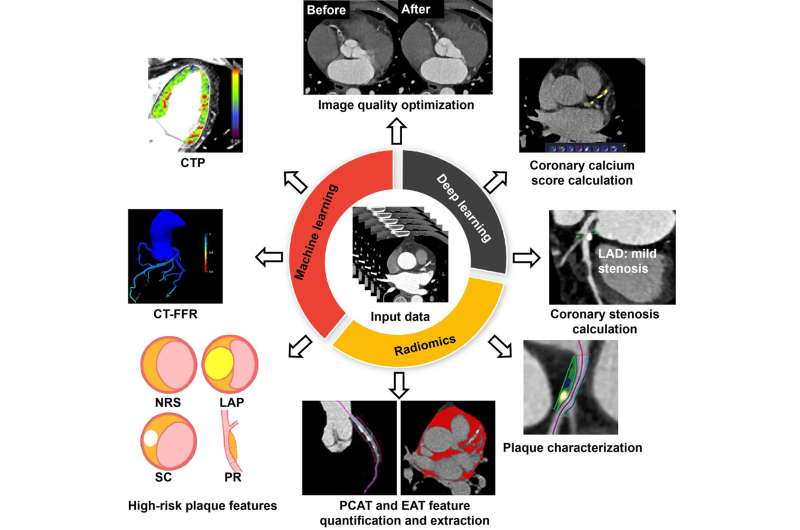 The application of AI technology in the diagnosis of cardiovascular diseases using coronary CT angiography (CCTA) has gradually deepened, and efficient and intelligent methods are optimizing and reshaping the clinical diagnosis pathways, including optimization of image quality, fully automated calculation of calcification score, coronary stenosis, quantitative and qualitative assessment of plaque components, quantification of perivascular and pericardiac fat, and calculation of non-invasive CT-derived fractional flow reserve (CT-FFR) and myocardial perfusion. Credit: Science China Press