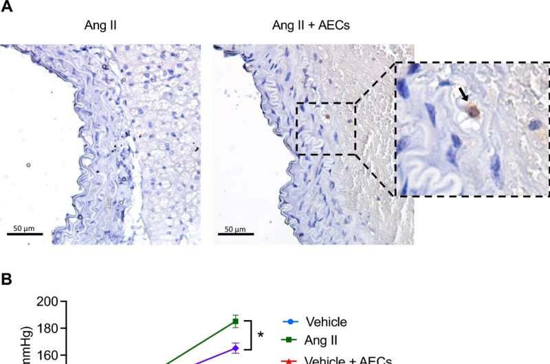 Angiotensin II induced-hypertension and aortic stiffening is reduced by administration of amnion epithelial cells. (A) Immunostaining for HLA-G in angiotensin II and angiotensin II + amnion epithelial cell (AEC) treated mice. (B) Effect of amnion epithelial cells (AECs) on angiotensin II-induced hypertension (n = 8–11). (C) Effect of angiotensin II infusion and co-treatment with AECs on pulse wave velocity (n = 6–7). (D) Delta change (day 0 and 14) of pulse wave velocity (n = 6–7). Credit: Scientific Reports (2024). DOI: 10.1038/s41598-024-52214-0