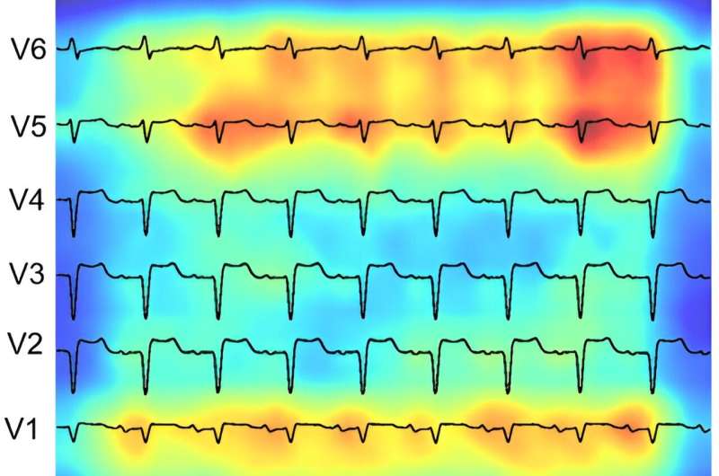 A deep learning-based ECG analysis tool is able to identify patients at high risk for poor right ventricular function. Areas deemed important by the AI for prediction are highlighted in increasing shades of red. Credit: Duong, et al., Journal of the American Heart Association